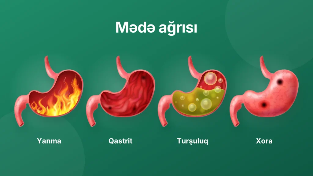 mədə ağrısı , mədə ağrısına nə yaxşıdır, qastrit, mədə xorası, reflüks, həzmsizlik, kürəyə vuran ağrı, stresdən mədə ağrısı, hamiləlikdə mədə ağrısı, antasidlər