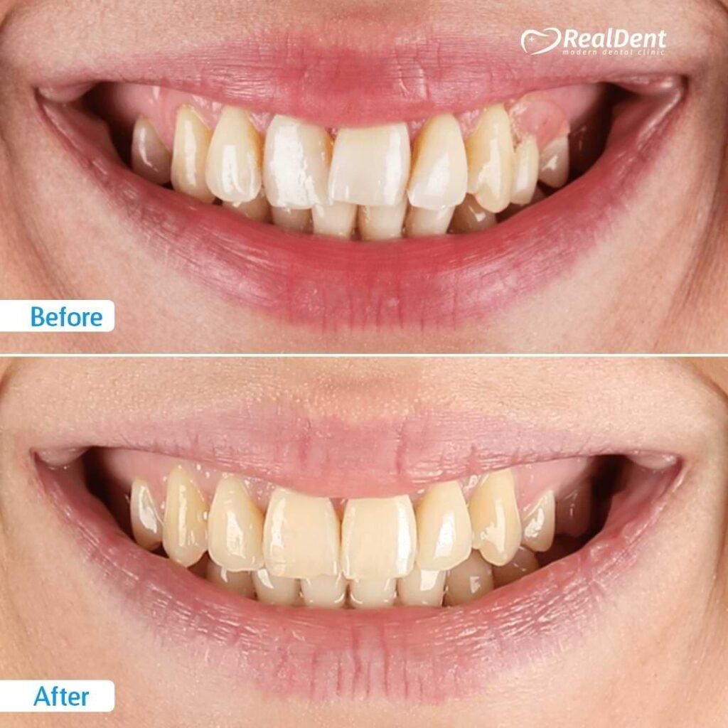 Ortodontiya
Şeffaf kappaları (Aligner)
3D çap texnologiyası
Liqatursuz breketlər
Diş düzəldilməsi